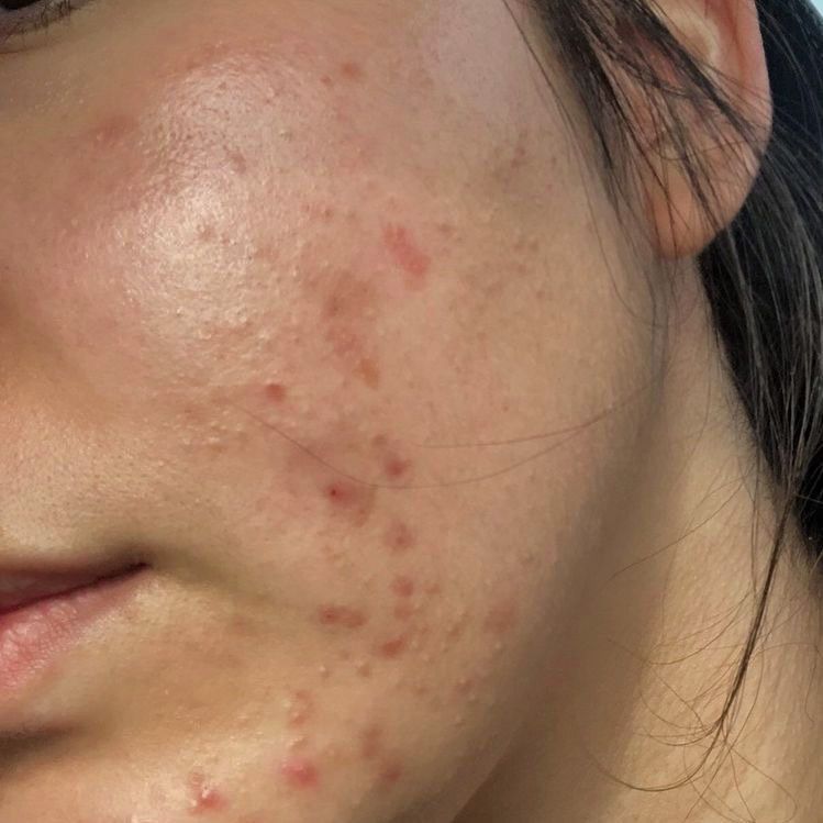 Da Dầu Có Cần Dưỡng Ẩm Không. Sự Thật Khiến Nhiều Người Bất Ngờ