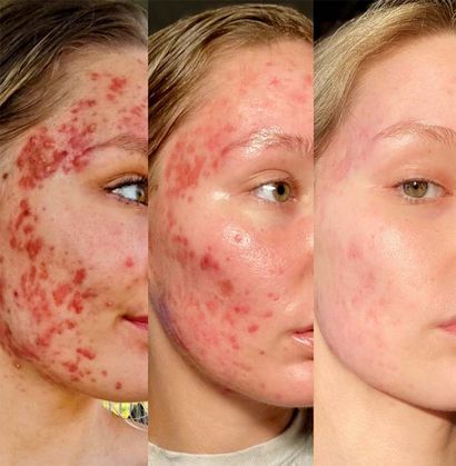 Isotretinoin Có Hiệu Quả Không? Sự Thật Bạn Cần Biết Trước Khi Dùng