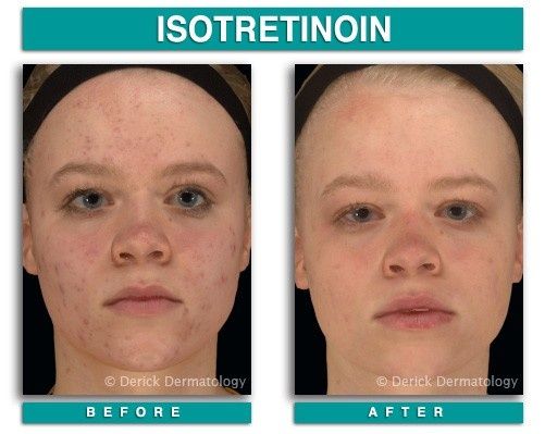 Isotretinoin Có Hiệu Quả Không
