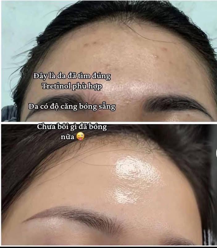 Ngưng Tretinoin Là Mụn Quay Lại – Vì Sao