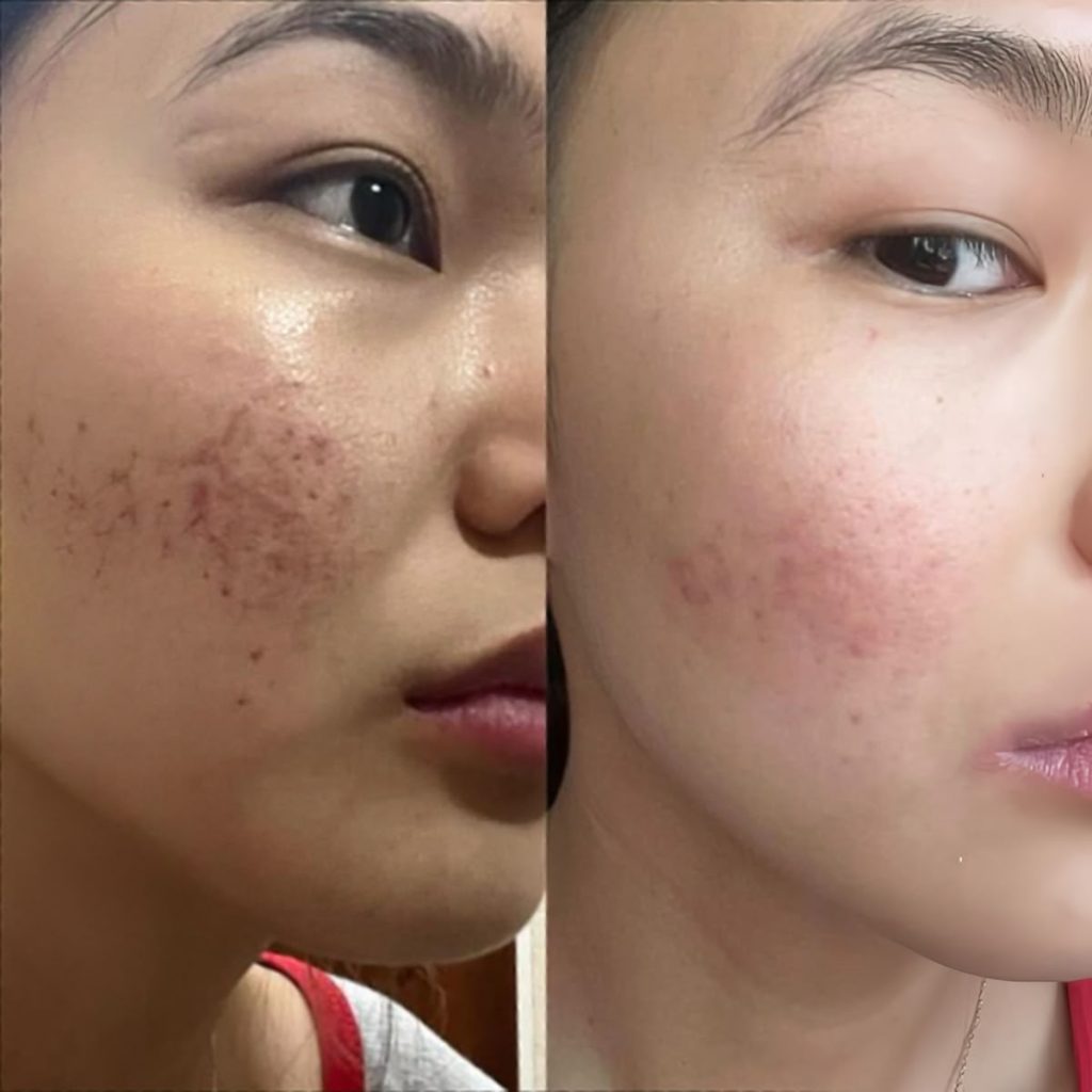 Trị Mụn Viêm Nặng. Giải Pháp An Toàn Không Để Lại Sẹo