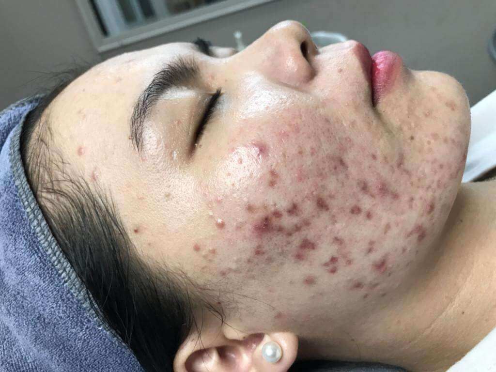 Trị Mụn Viêm Nặng. Giải Pháp An Toàn Không Để Lại Sẹo