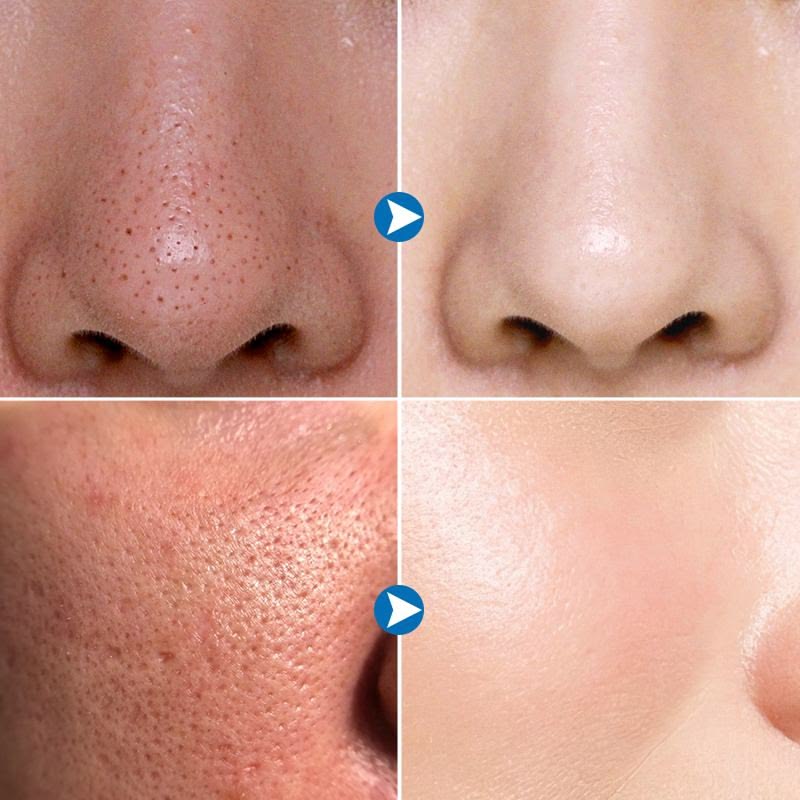 Vì sao càng lột mụn đầu đen thì lỗ chân lông càng to