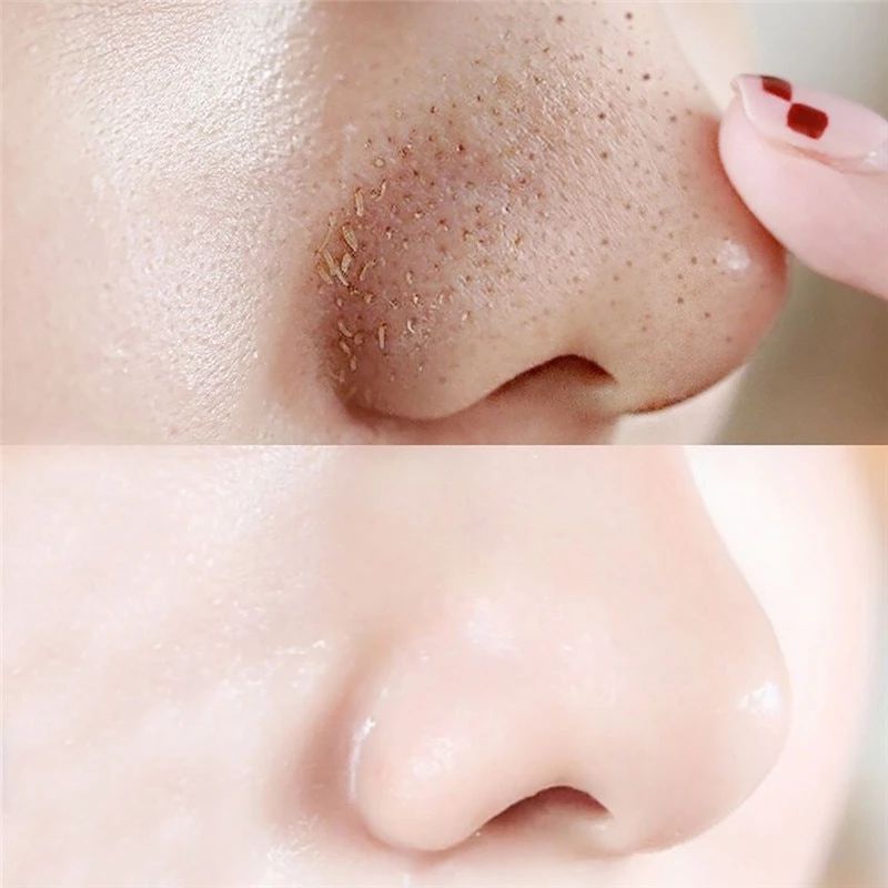 Vì sao càng lột mụn đầu đen thì lỗ chân lông càng to