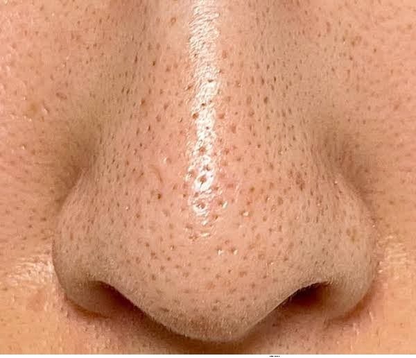 Vì sao càng lột mụn đầu đen thì lỗ chân lông càng to