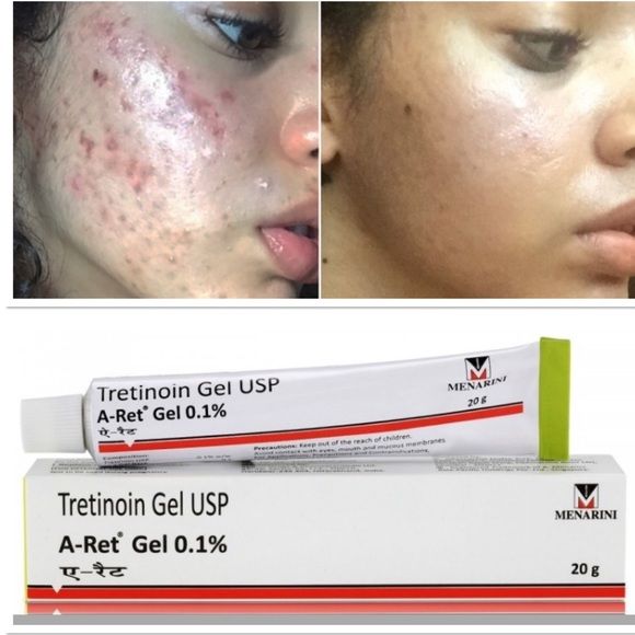 Tretinoin Có Đẩy Mụn Không