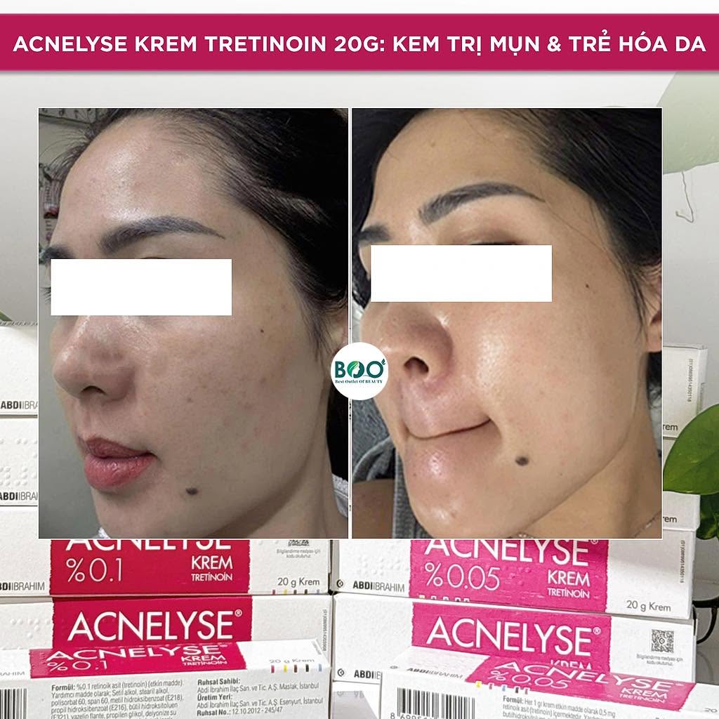Bao Lâu Thì Hết Purging Khi Dùng Tretinoin