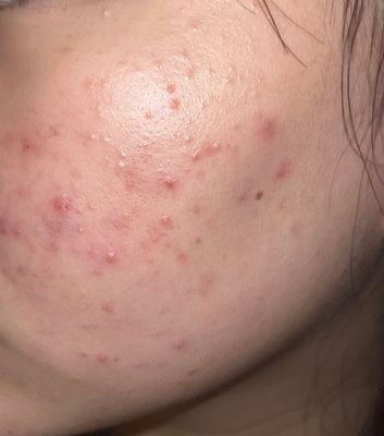 Điều Gì Khiến Mụn Nội Tiết Khó Điều Trị Hơn