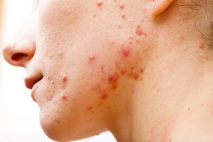 Điều Gì Khiến Mụn Nội Tiết Khó Điều Trị Hơn