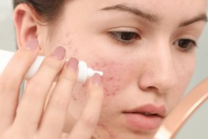 Tretinoin 0.05% Có Mạnh Không?