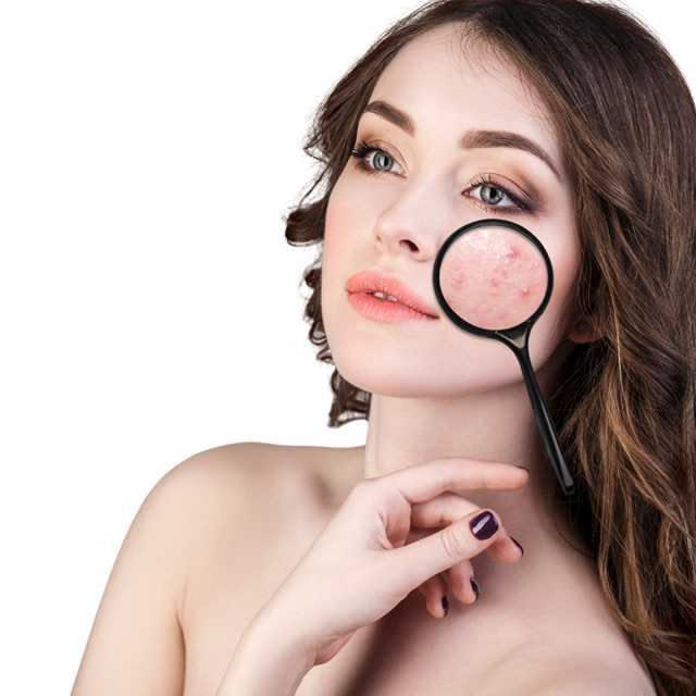 Tretinoin Bị Đẩy Mụn Bao Lâu
